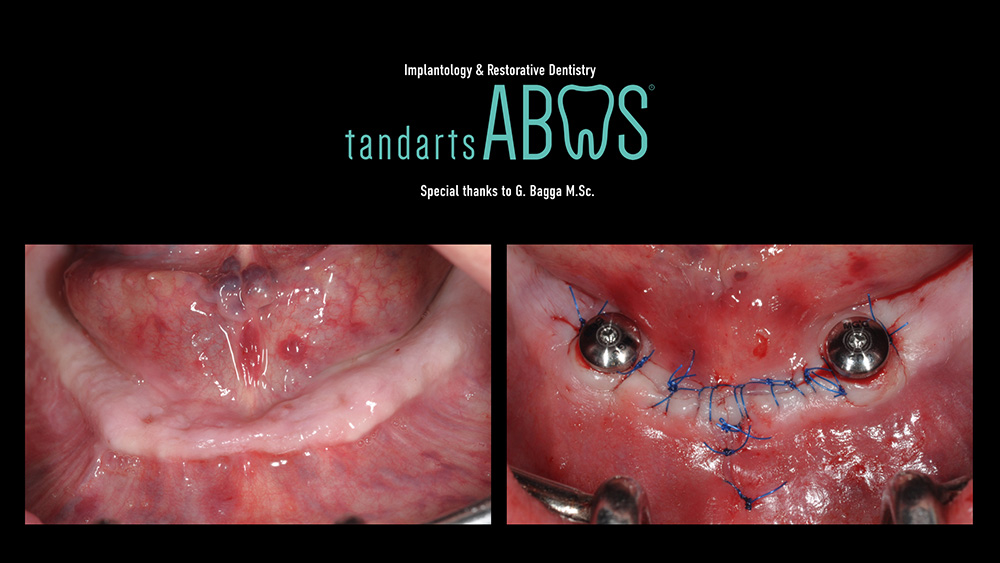 Two implants in the edentulous mandible using a 1-stage ExFeel implant.013