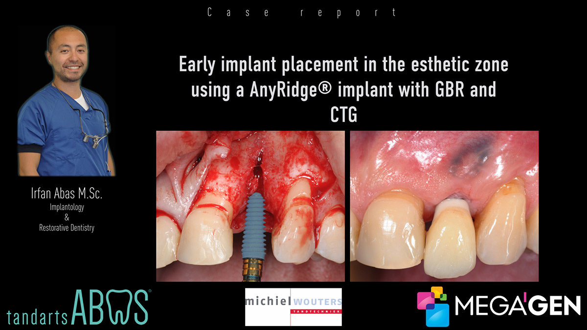 Early implant placement in the esthetic zone with GBR and