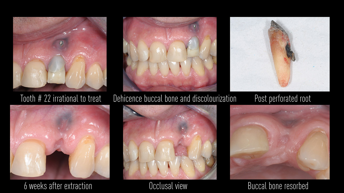 Early implant placement in the esthetic zone with GBR and
