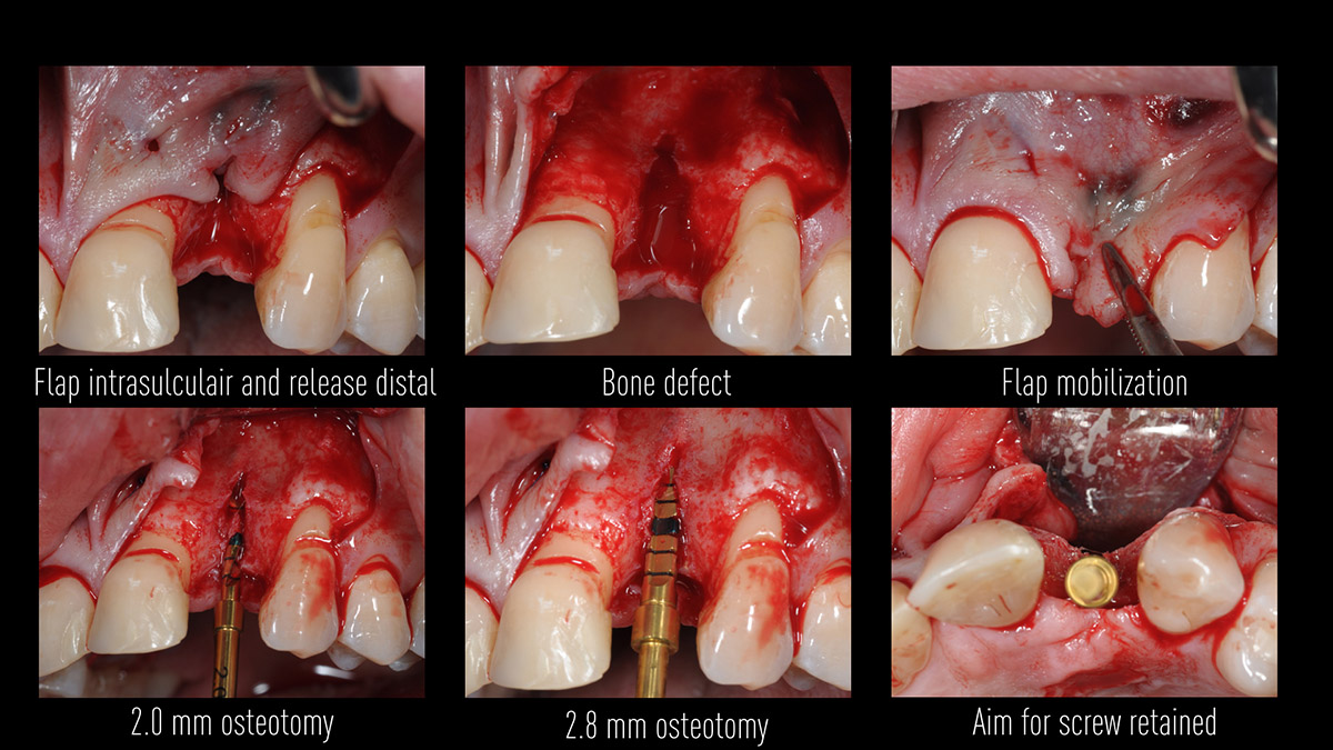 Early implant placement in the esthetic zone with GBR and