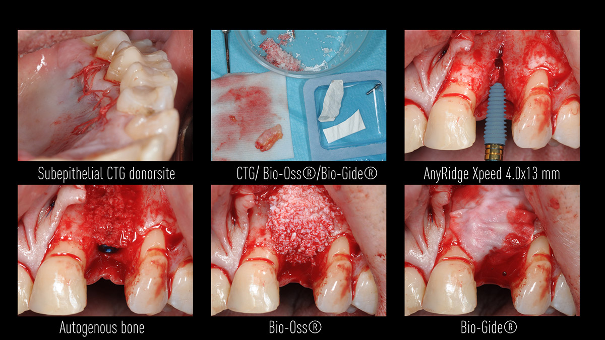Early implant placement in the esthetic zone with GBR and