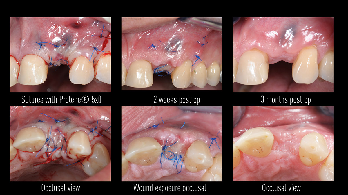 Early implant placement in the esthetic zone with GBR and