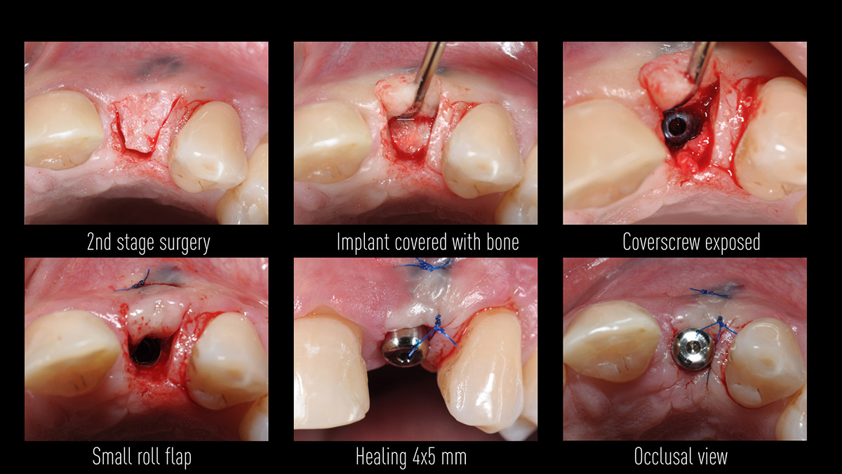 Early implant placement in the esthetic zone with GBR and