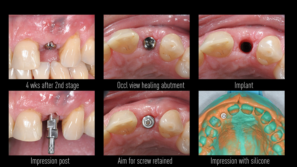 Early implant placement in the esthetic zone with GBR and