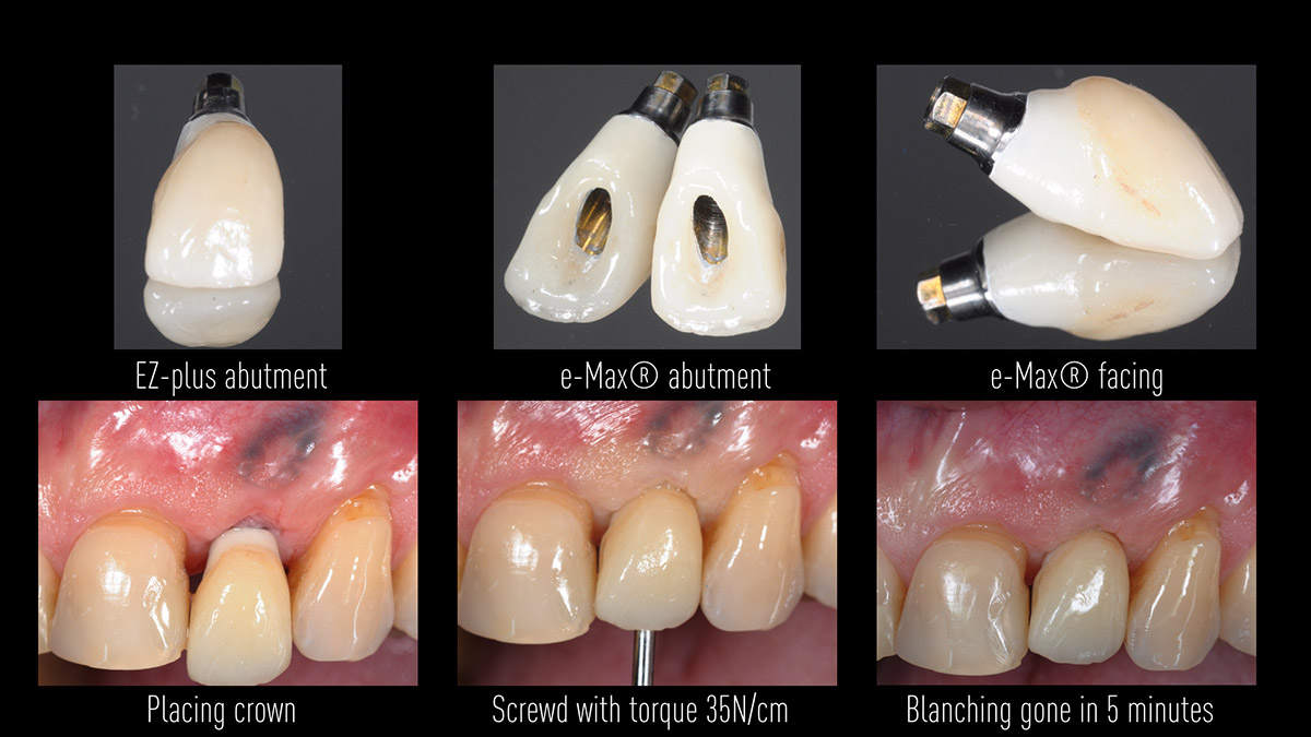 Early implant placement in the esthetic zone with GBR and