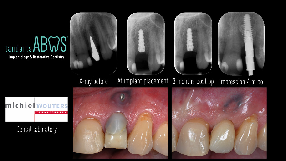 Early implant placement in the esthetic zone with GBR and