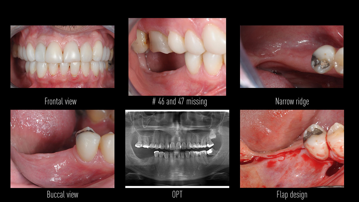Placement-of-2-AnyOne-implants-in-mandible-molar-area