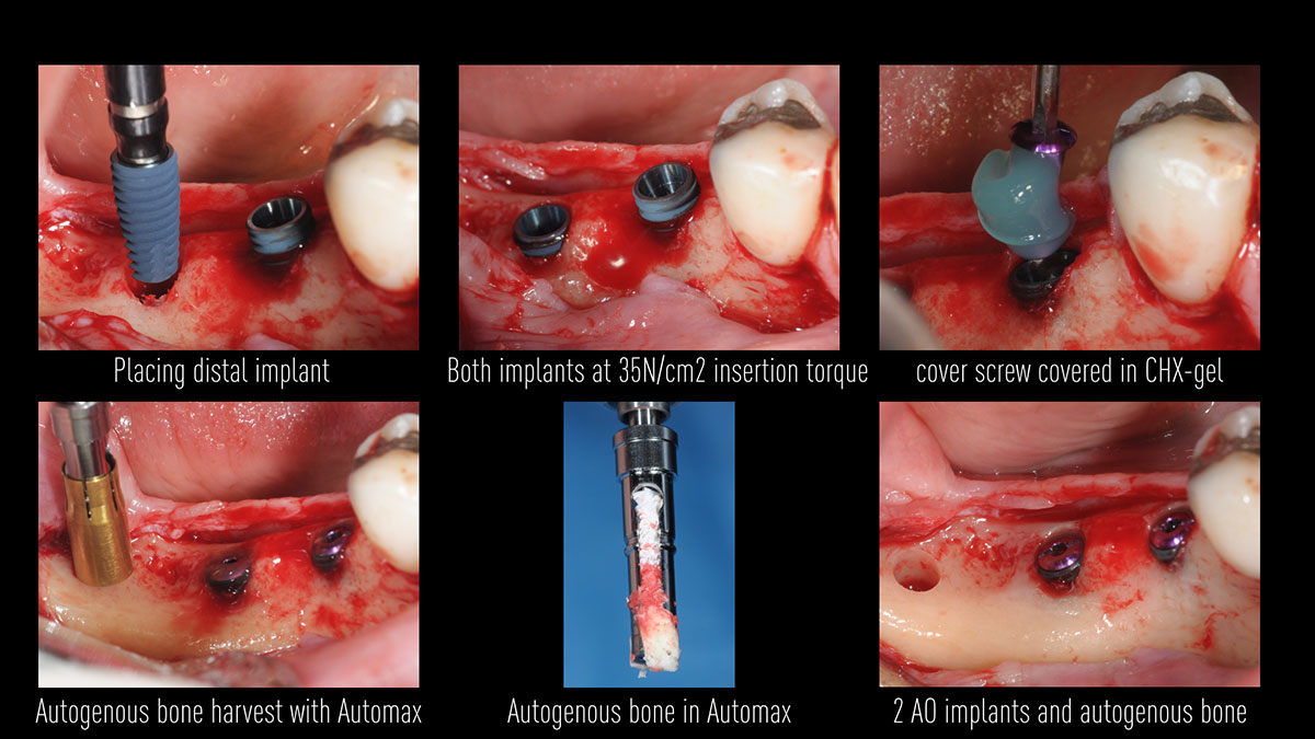 Placement-of-2-AnyOne-implants-in-mandible-molar-area
