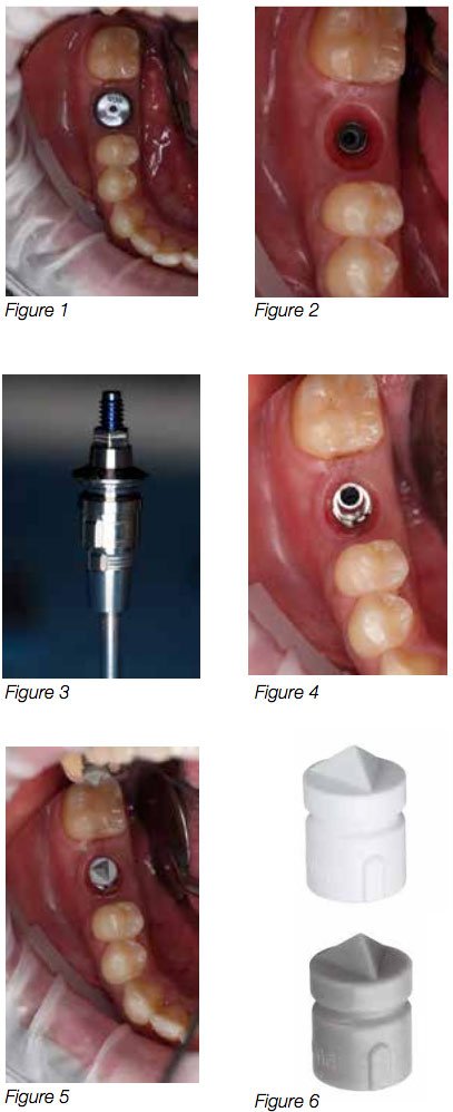 cerec scanpost options