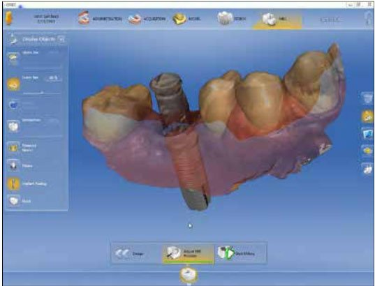 cerec scanpost options