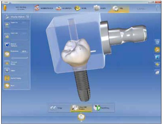 cerec scanpost options