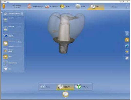 cerec scanpost options
