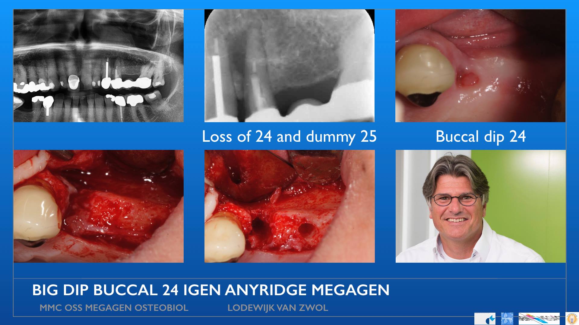 MegaGen AnyRidge with IGen icw OsteoBiol GenOs and Evolution