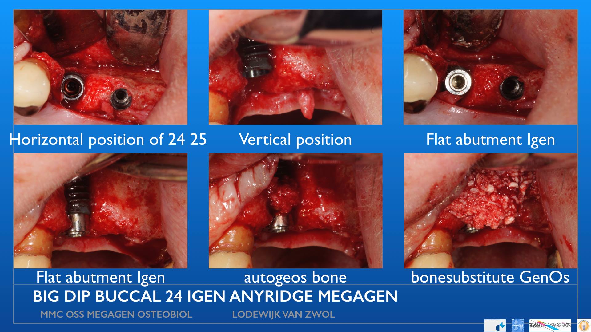 MegaGen AnyRidge with IGen icw OsteoBiol GenOs and Evolution