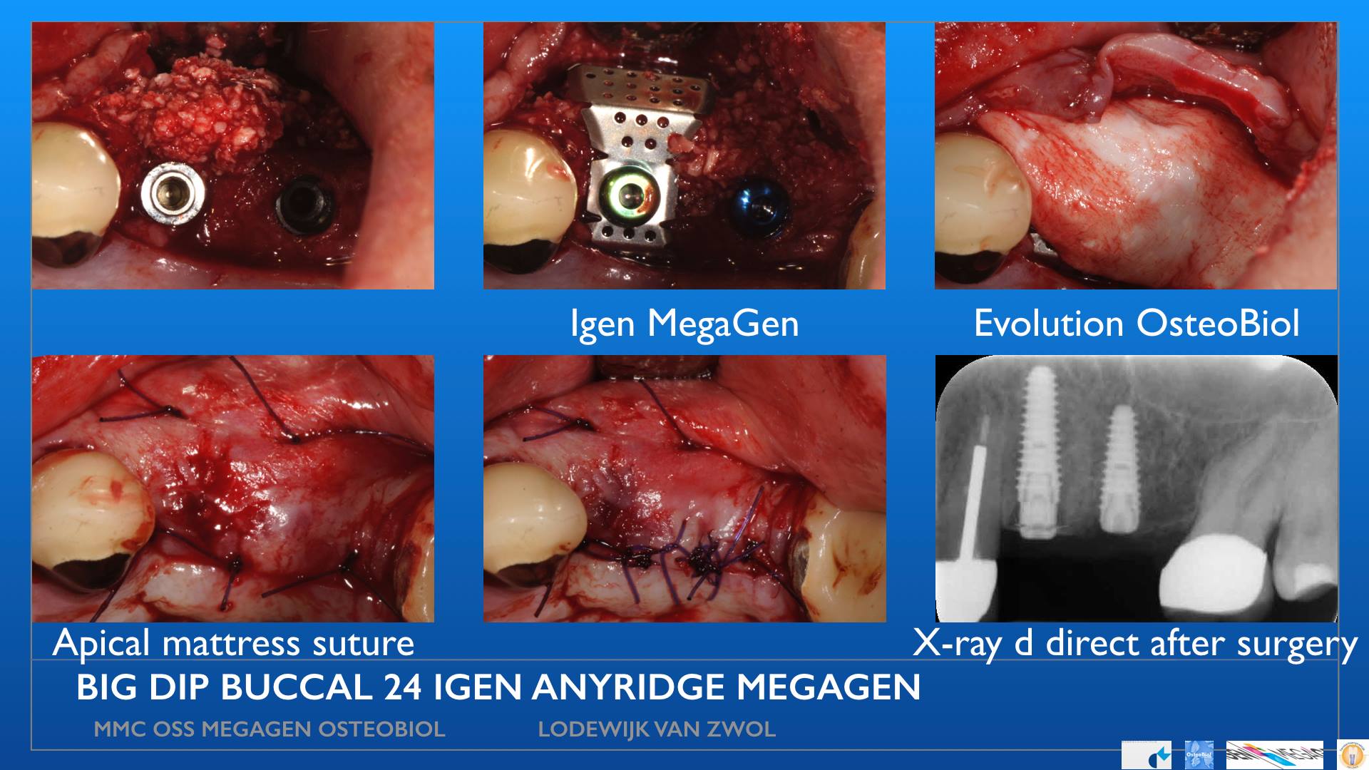 MegaGen AnyRidge with IGen icw OsteoBiol GenOs and Evolution