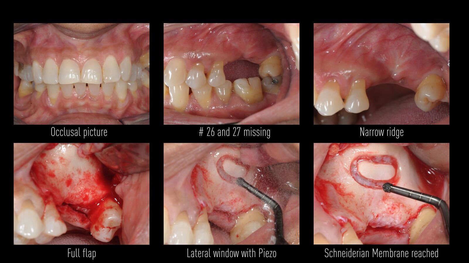 placement-of-2-ar-implants-with-sinus-floor-elevation