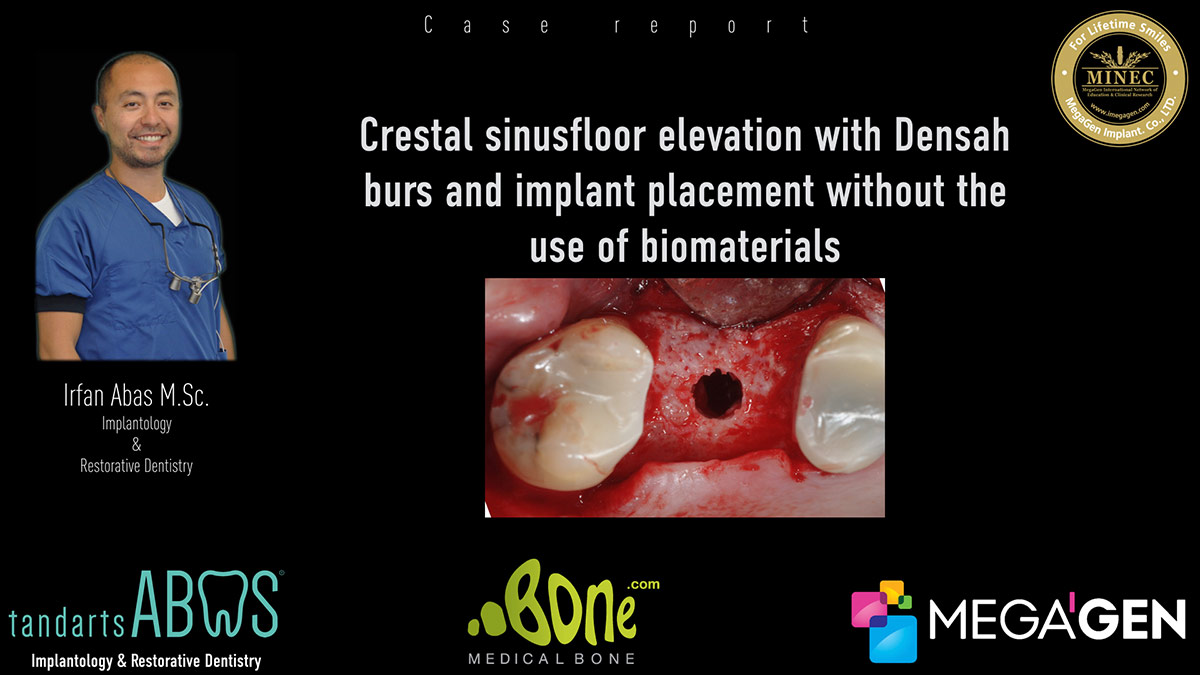Crestal-sinusfloor-elevation-with-Densah-burs-and-implant-placement-without-the-use-of-biomaterials