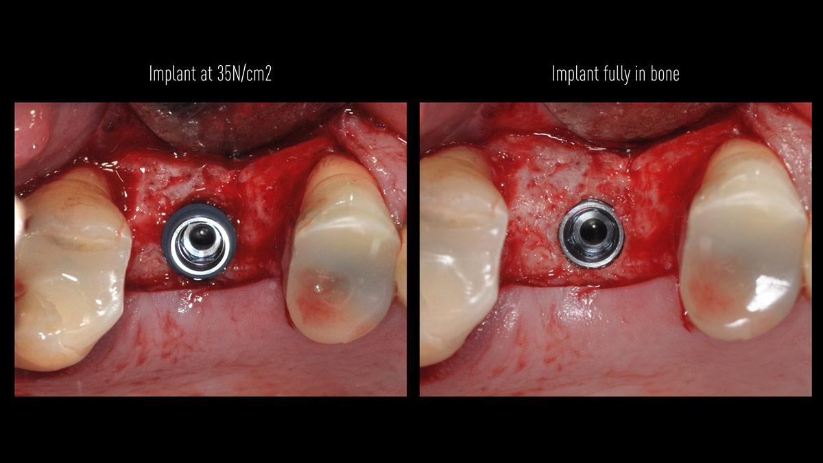 Crestal-sinusfloor-elevation-with-Densah-burs-and-implant-placement-without-the-use-of-biomaterials