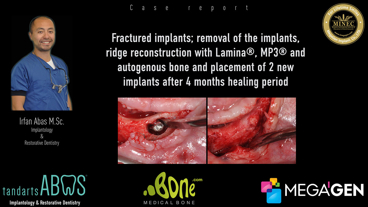 Fractured implants; removal of the implants, ridge reconstruction with Lamina®, MP3® and autogenous bone and placement of 2 new implants after 4 months healing period