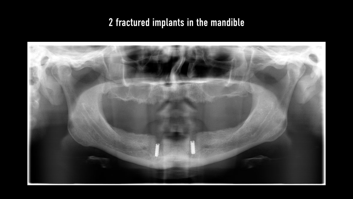 Fractured implants; removal of the implants, ridge reconstruction with Lamina®, MP3® and autogenous bone and placement of 2 new implants after 4 months healing period