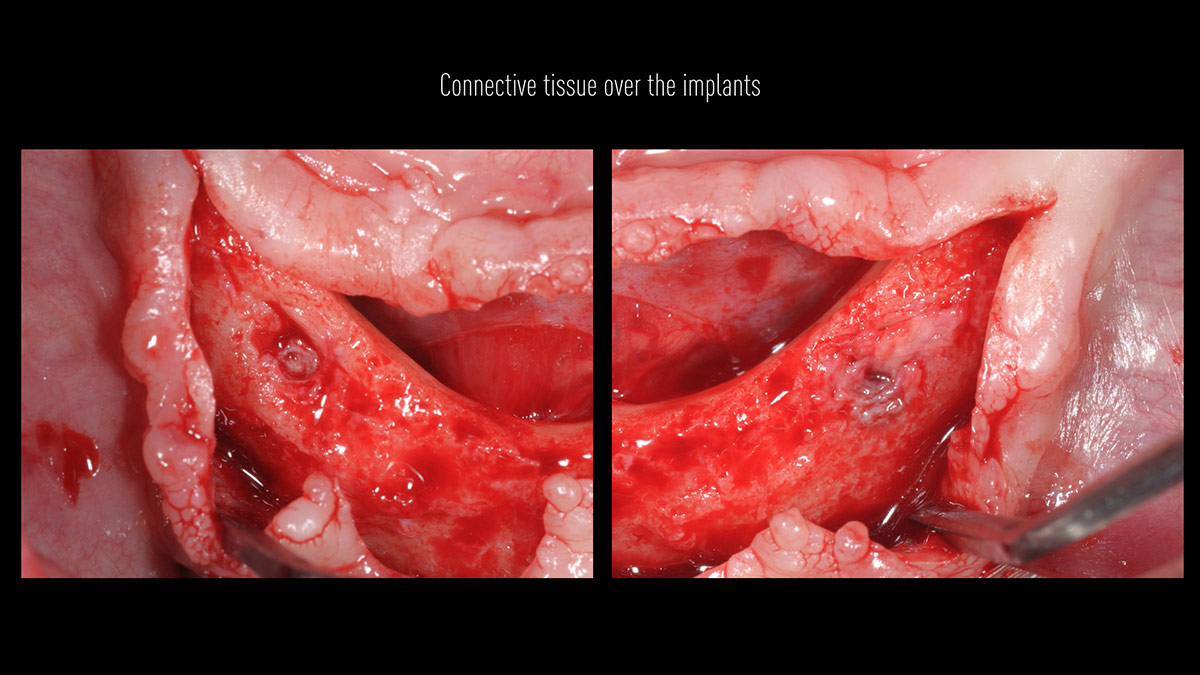 Fractured implants; removal of the implants, ridge reconstruction with Lamina®, MP3® and autogenous bone and placement of 2 new implants after 4 months healing period