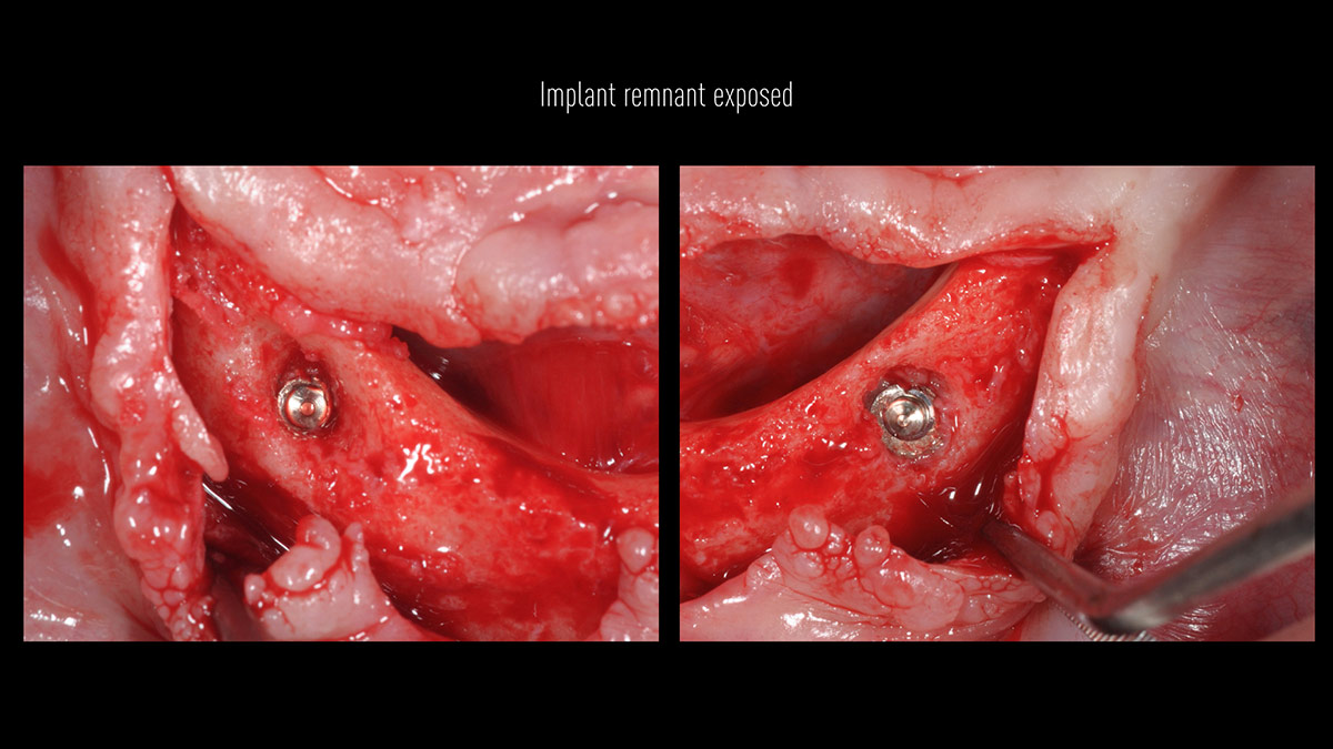 Fractured implants; removal of the implants, ridge reconstruction with Lamina®, MP3® and autogenous bone and placement of 2 new implants after 4 months healing period