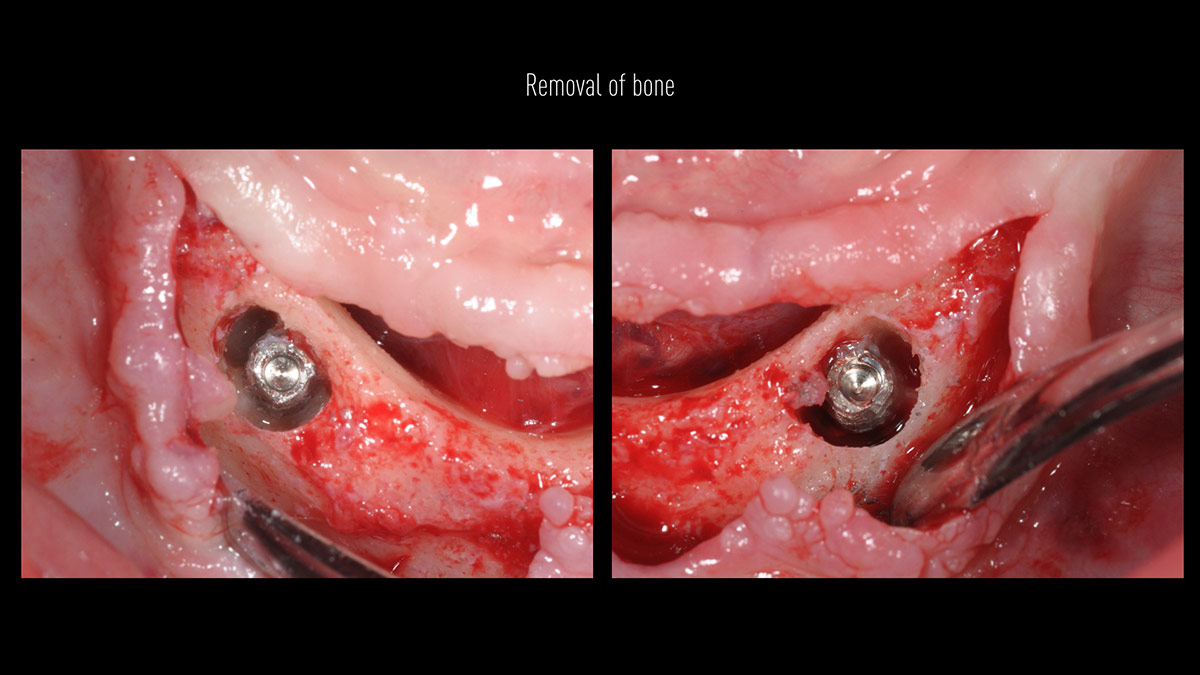 Fractured implants; removal of the implants, ridge reconstruction with Lamina®, MP3® and autogenous bone and placement of 2 new implants after 4 months healing period