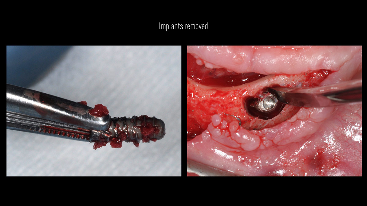 Fractured implants; removal of the implants, ridge reconstruction with Lamina®, MP3® and autogenous bone and placement of 2 new implants after 4 months healing period