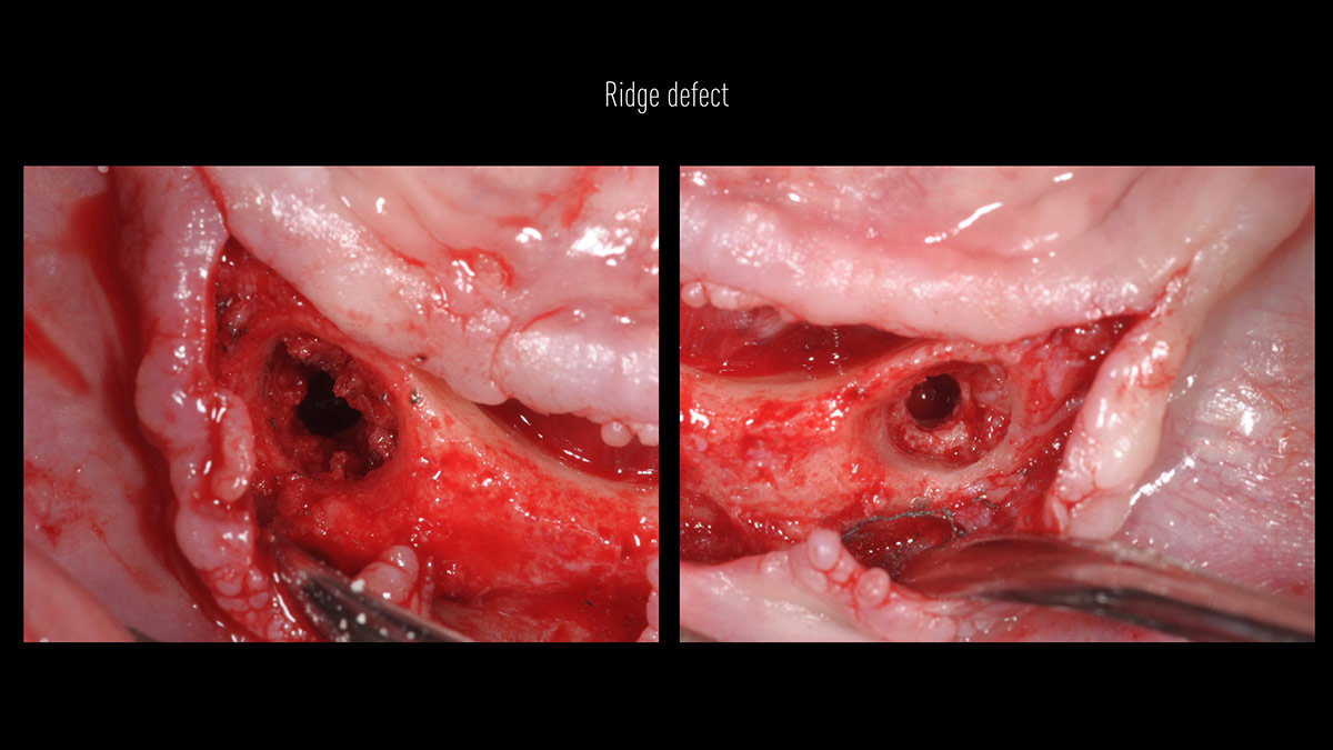 Fractured implants; removal of the implants, ridge reconstruction with Lamina®, MP3® and autogenous bone and placement of 2 new implants after 4 months healing period