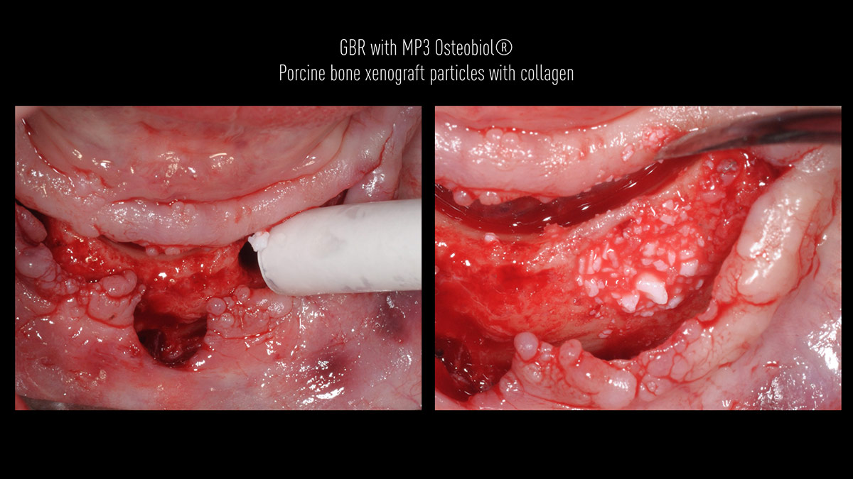 Fractured implants; removal of the implants, ridge reconstruction with Lamina®, MP3® and autogenous bone and placement of 2 new implants after 4 months healing period