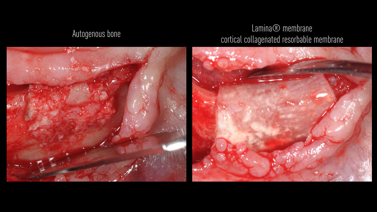 Fractured implants; removal of the implants, ridge reconstruction with Lamina®, MP3® and autogenous bone and placement of 2 new implants after 4 months healing period