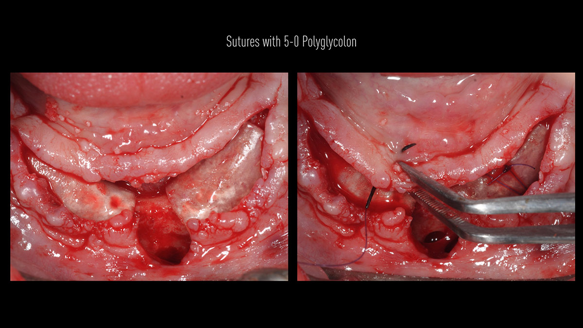 Fractured implants; removal of the implants, ridge reconstruction with Lamina®, MP3® and autogenous bone and placement of 2 new implants after 4 months healing period