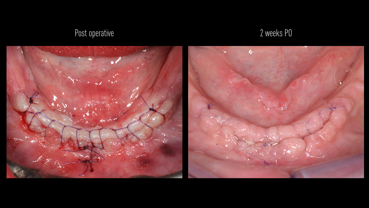 Fractured implants; removal of the implants, ridge reconstruction with Lamina®, MP3® and autogenous bone and placement of 2 new implants after 4 months healing period