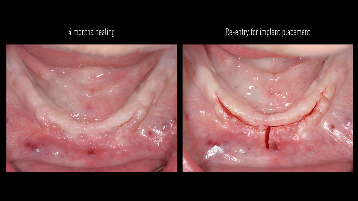Fractured implants; removal of the implants, ridge reconstruction with Lamina®, MP3® and autogenous bone and placement of 2 new implants after 4 months healing period