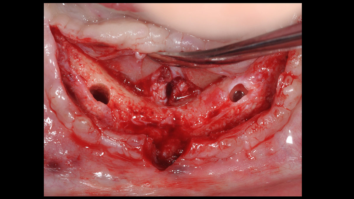 Fractured implants; removal of the implants, ridge reconstruction with Lamina®, MP3® and autogenous bone and placement of 2 new implants after 4 months healing period