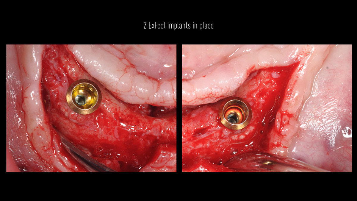 Fractured implants; removal of the implants, ridge reconstruction with Lamina®, MP3® and autogenous bone and placement of 2 new implants after 4 months healing period