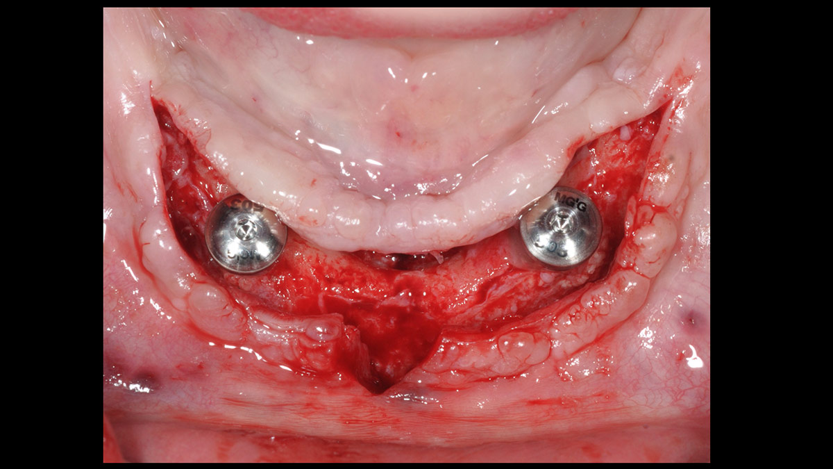Fractured implants; removal of the implants, ridge reconstruction with Lamina®, MP3® and autogenous bone and placement of 2 new implants after 4 months healing period