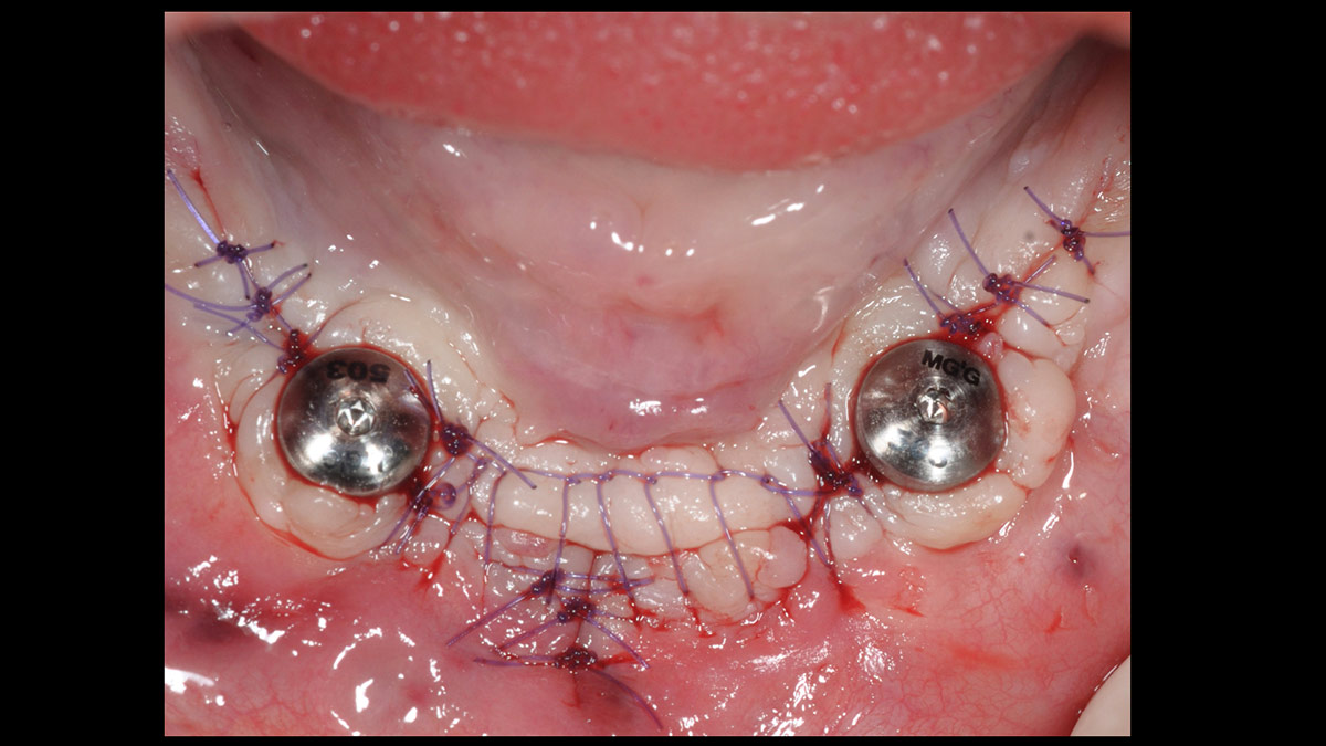 Fractured implants; removal of the implants, ridge reconstruction with Lamina®, MP3® and autogenous bone and placement of 2 new implants after 4 months healing period