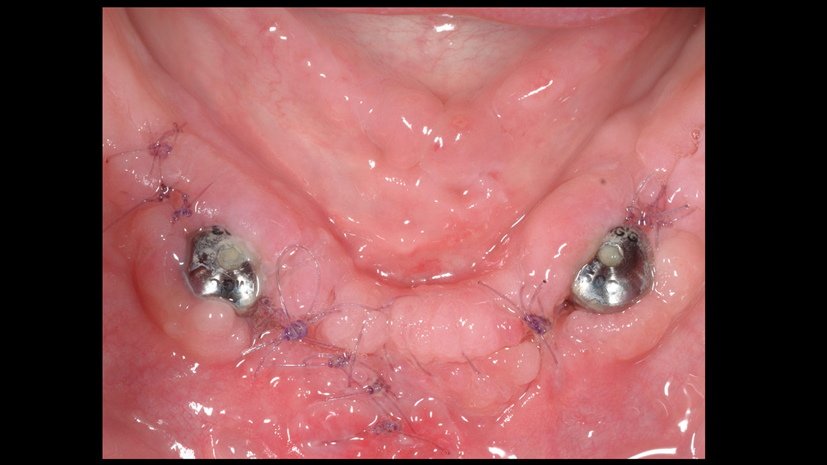 Fractured implants; removal of the implants, ridge reconstruction with Lamina®, MP3® and autogenous bone and placement of 2 new implants after 4 months healing period