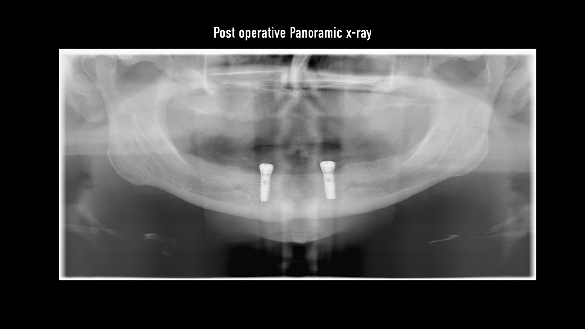 Fractured implants; removal of the implants, ridge reconstruction with Lamina®, MP3® and autogenous bone and placement of 2 new implants after 4 months healing period