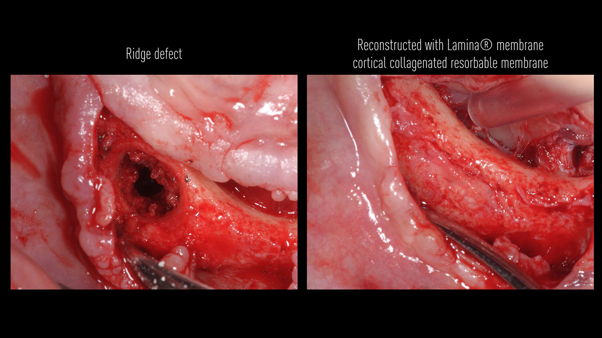 Fractured implants; removal of the implants, ridge reconstruction with Lamina®, MP3® and autogenous bone and placement of 2 new implants after 4 months healing period