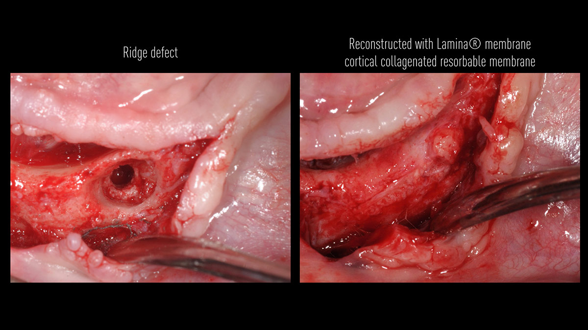 Fractured implants; removal of the implants, ridge reconstruction with Lamina®, MP3® and autogenous bone and placement of 2 new implants after 4 months healing period