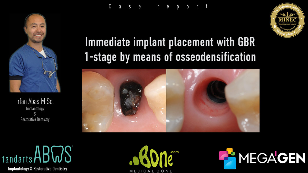 Immediate-implant-placement-with-GBR-1-stage