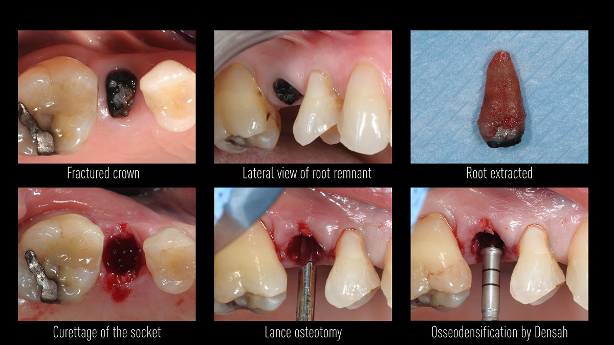 Immediate-implant-placement-with-GBR-1-stage