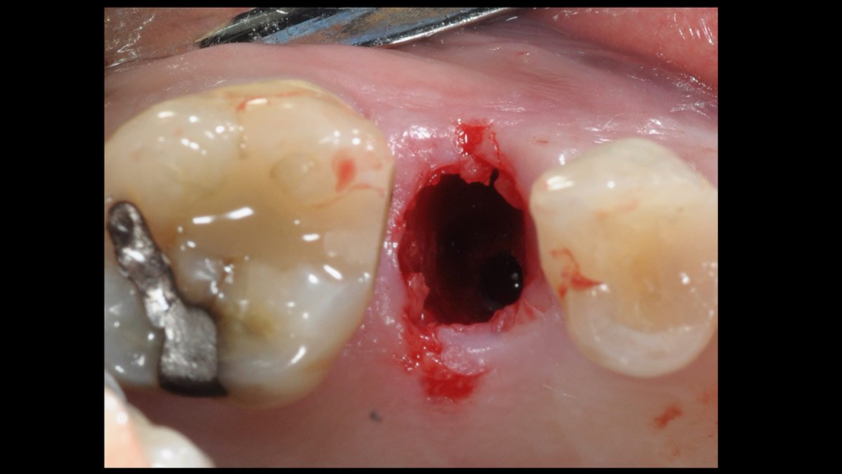 Immediate-implant-placement-with-GBR-1-stage