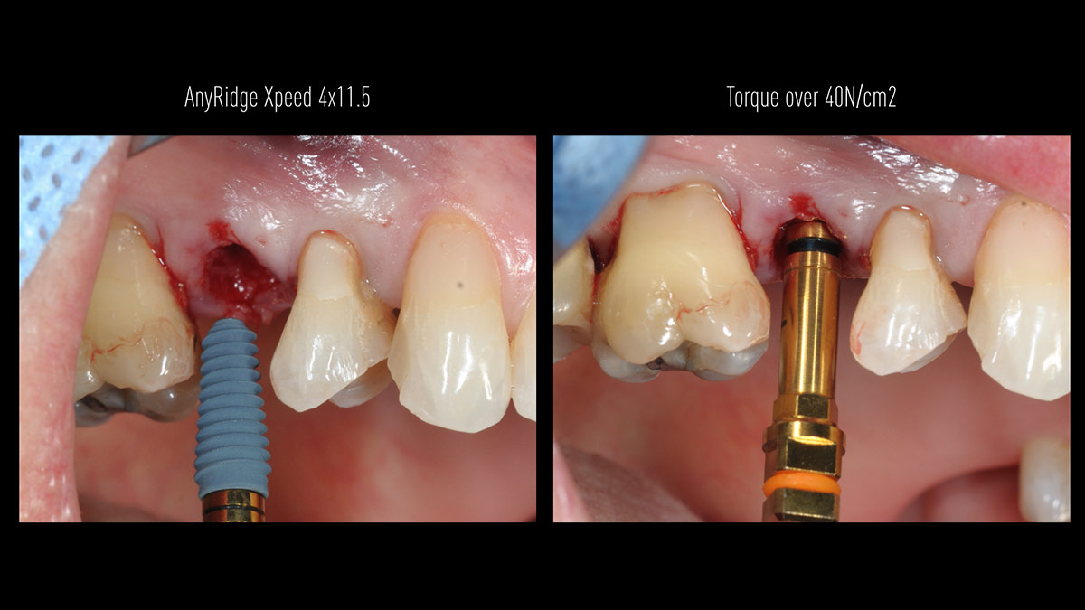 Immediate-implant-placement-with-GBR-1-stage
