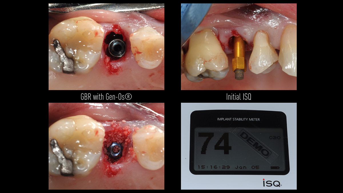 Immediate-implant-placement-with-GBR-1-stage