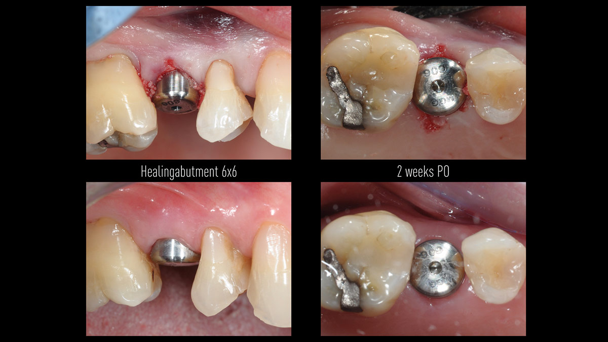 Immediate-implant-placement-with-GBR-1-stage