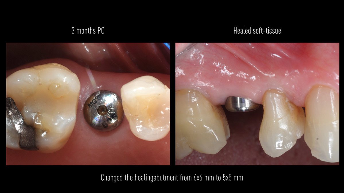 Immediate-implant-placement-with-GBR-1-stage