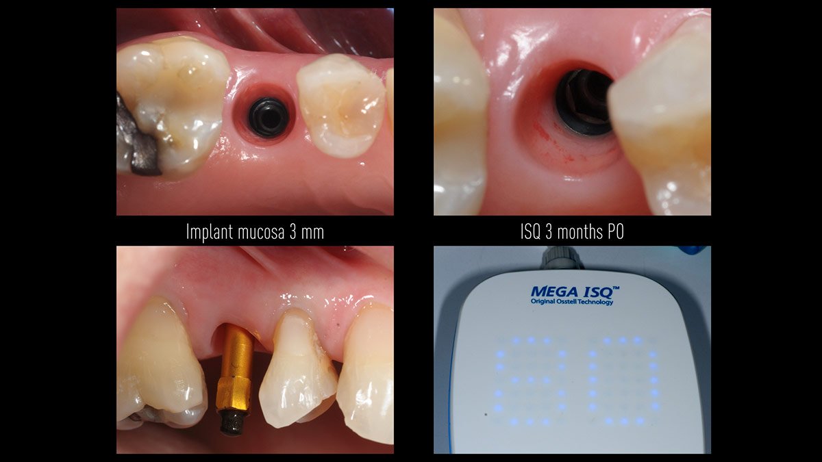Immediate-implant-placement-with-GBR-1-stage